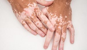 Does Medicare Cover Vitiligo Treatment? What You Need to Know