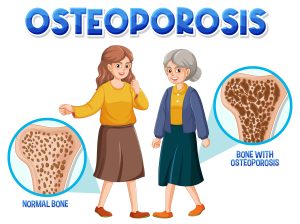 Understanding-Medicare-Coverage-for-Osteoporosis-What-You-Need-to-Know